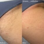 Depiladora sistema español